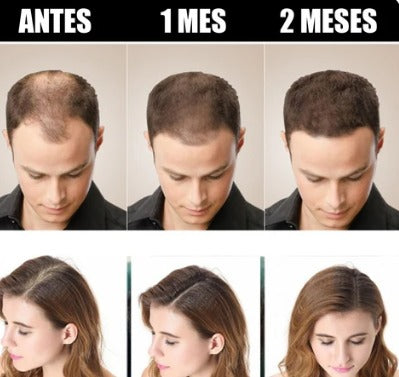 💆‍♂️ Aceite Anti-Caída + Spray Crecimiento GRATIS 🎁